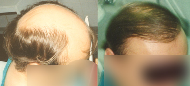 Transplantace vlasů 7